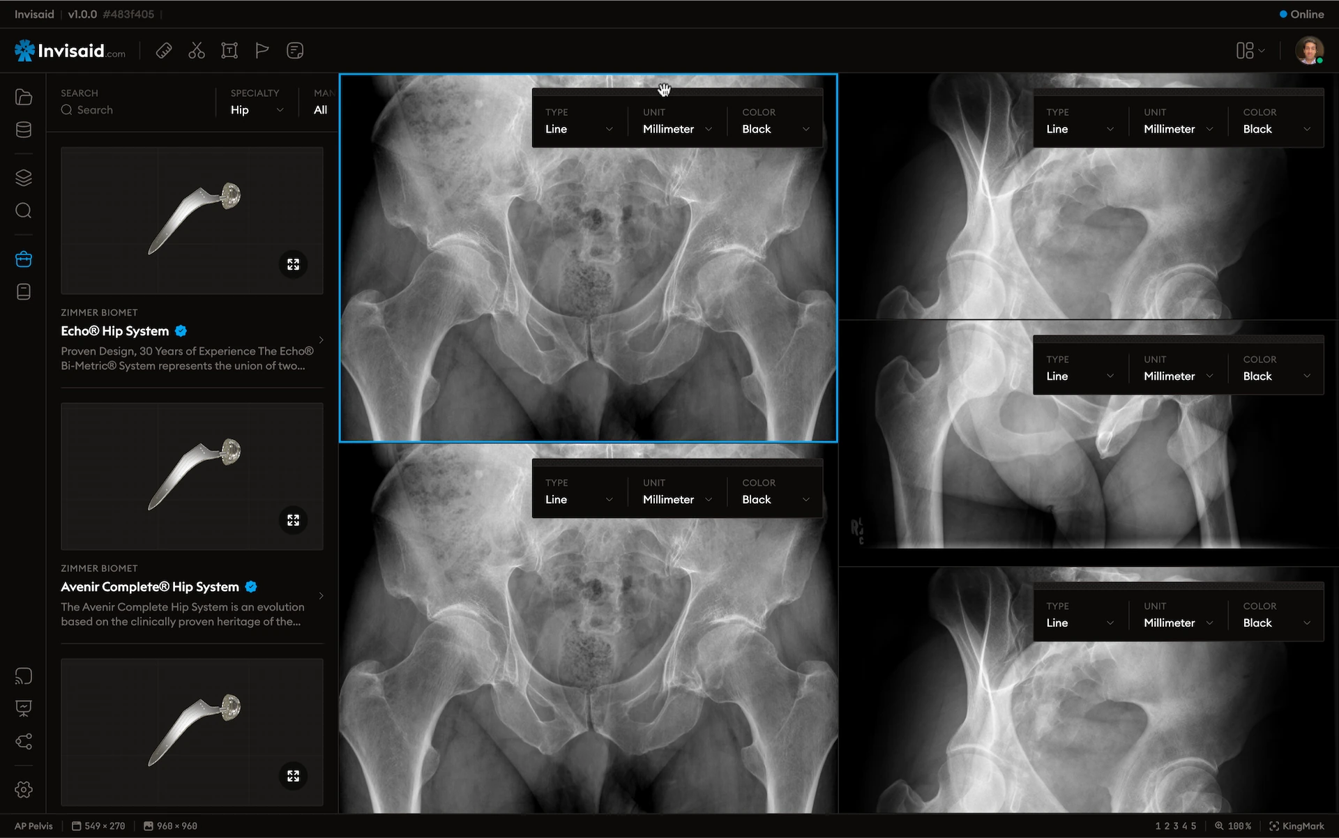 A screenshot of Invisaid, the surgical preoperative orthopedic planning software, in dark mode.