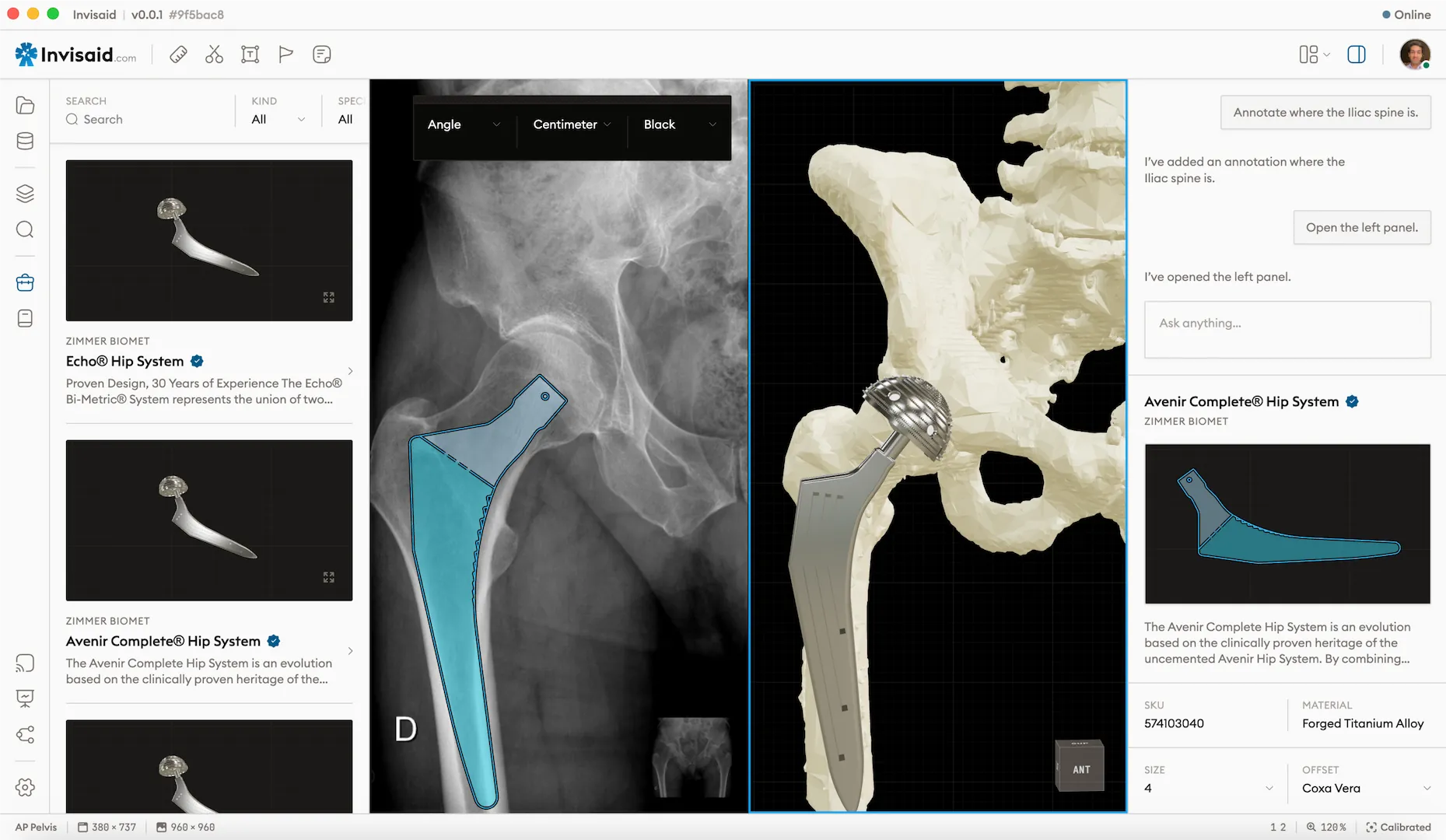 A screenshot of Invisaid, the surgical preoperative orthopedic planning software showcasing a total hip replacement procedure being planned with the Zimmer Biomet Avenir Hip System.
